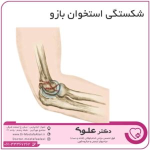 شکستگی استخوان بازو دکتر مصطفی علوی