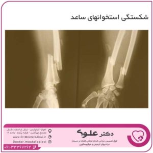 شکستگی استخوانهای ساعد دکتر مصطفی علوی