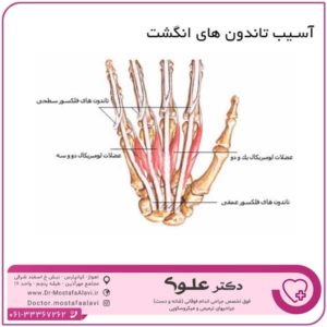 آسیب تاندون های انگشت دکتر مصطفی علوی