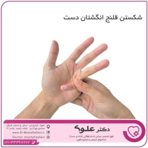 شکستن قلنج انگشتان دست دکتر مصطفی علوی