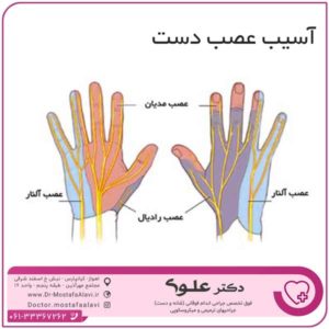 آسیب عصب دست دکتر مصطفی علوی