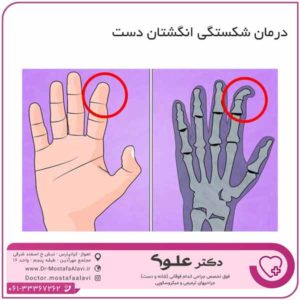 درمان شکستگی انگشتان دست دکتر مصطفی علوی