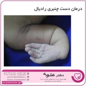 درمان دست چنبری رادیال دکتر مصطفی علوی